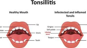 Hasil gambar untuk TONSILITIS