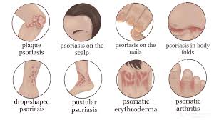 Image result for psoriasis