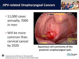 The type of hpv that causes warts does not cause cancers. Hpv Cancer Male Symptoms Cancer In Males From Hpv