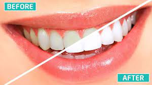 Cara memutihkan gigi secara alami bisa dilakukan dengan memadukan jeruk nipis dan garam. Cara Memutihkan Gigi Secara Permanen Dalam Waktu Singkat 100 Ampuh Youtube