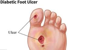 Throat ulcers often feel like a lump in your throat and cause pain while you're swallowing. What Is The Best Way To Treat Diabetes Foot Ulcers Quora