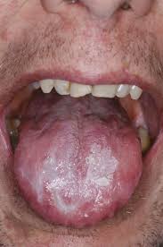 Image result for lichen planus on tongue)