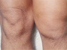 We did not find results for: Reactive Arthritis Wikipedia