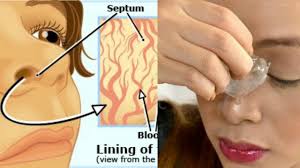 Ini termasuklah masalah hidung tersumbat yang mungkin dianggap resdung, sakit kepala yang beliau bagaimanapun menggariskan dua simptom utama yang wajib diberi perhatian iaitu hidung. Mendongak Bila Hidung Berdarah Adalah Salah Ni 7 Step Patut Buat Bila Hidung Berdarah