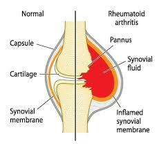 Image result for Rheumatoid Factor
