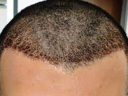Should I Remove Scabs After Hair Transplant Surgery Hair Loss Q A Hair Transplant Surgery Hair Transplant Hair Implants