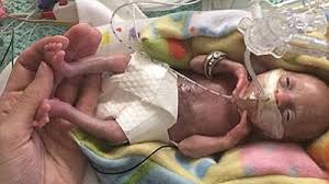 Jan 08, 2021 · fetal movement: Born Before 22 Weeks Most Premature Baby Is Now Thriving The Baltimore Times Online Newspaper Positive Stories About Positive People