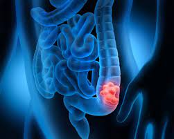 For many, cancer is the first thing that comes to mind when experiencing blood in their stool for the first time. Colorectal Cancer In Women Mistaking Your Abdominal Discomfort For Pms