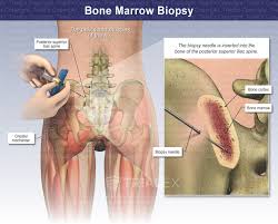 Image result for Bone Marrow Exam