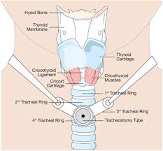 Image result for Tracheostomy