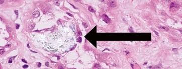 L'oxalate provient de nombreux aliments de notre alimentation. La Nephropathie Aigue A Oxalates En Cas De Pancreatite Chronique Forum Medical Suisse