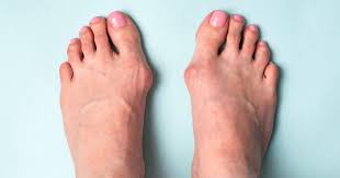 Hallux Valgus Ursachen Behandlung Und Ubungen Liebscher Bracht