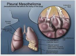 The Causes Of Mesothelioma Cancer Coralines