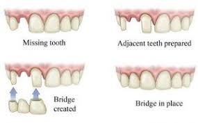In wales, the cost is £47.00and in scotland and northern ireland the prices vary. Cost Of Removal Of Wisdom Teeth Uk
