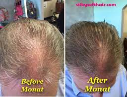 Another Great Before And After That I Owe To Monat The Best Company Ever All Hands Down They Have Produc Monat Hair Hair Growth For Men Hair Restoration