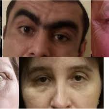 a Relevant surgical anatomy landmarks for transpalpebral approach....