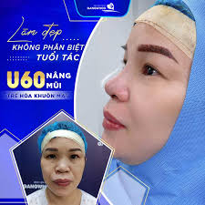 Nâng Mũi Dáng Trung Hoa