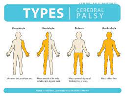 Doctors classify cp according to the main type of movement disorder involved. Maksud Cerebral Palsy Kisah Benar Pengorbanan Ibu Pada Anaknya