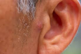 Pimples in the Ear: Symptoms, Causes, and Treatment