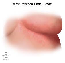 Image result for Intertrigo under breasts
