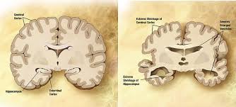 30 6d Aging And The Nervous System Medicine Libretexts