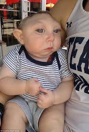 Miracle baby born with part of his brain and skull missing celebrates his  first birthday