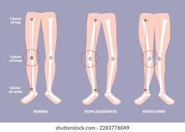 Image result for Genu Varum