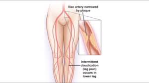 Peripheral Arterial Disease Society For Vascular Surgery