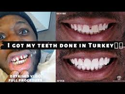Extractions, root canals, crown/bridges and dentures: I Got My Teeth Done In Turkey Emax Veneer Procedure And Experience Vlog Youtube