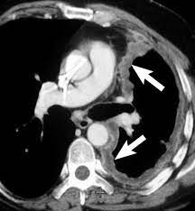 ct scans and mris for mesothelioma analysis. Malignant Pleural Mesothelioma Evaluation With Ct Mr Imaging And Pet Radiographics