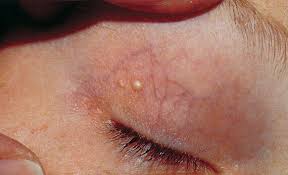 Image result for milium cyst on eyelid