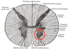 Image result for Progressive Bulbar Paralysis