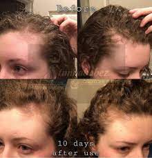 Rice Water For Hair Benefits And Side Effects Hair Adviser Rice Water For Hair Hair Loss Men Hair Loss Treatment