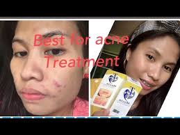 When you read reviews of this belo acnepro pimple gel formula in online stores like beautymnl, it has glowing reviews, mostly four to five stars. The Best For Acne Treatment The T3 Mycin Clindamycin Lotion Youtube