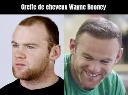 Wayne Rooney : greffe de cheveux