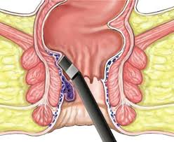 Hemorrhoids Hemorrhoids Treatment Hemorrhoids Natural Remedy For Hemorrhoids