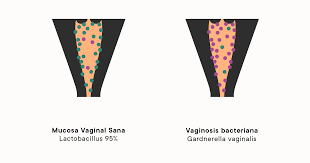 Vaginosis Bacteriana Razon Comun Para El Flujo Vaginal Irregular