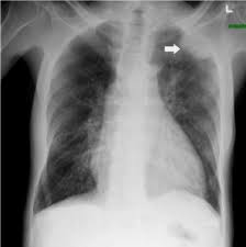 If it is suspected that someone has mesothelioma, or any other form of cancer, a number of tests will be ordered. Malignant Pleural Mesothelioma Presenting With Cardiac Tamponade A Rare Case Report And Review Of The Literature