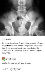 Buzz lightyear of star command is an american children's animated television series produced by walt disney television animation in collaboration with pixar. Nzafro An X Ray Showing A Buzz Lightyear Action Figure Lodged In The Anal Cavity The Patient Explained That It Got Stuck When It Was Inserted And A Button Was Accidentally Pushed Extending