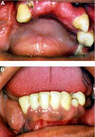 Image result for granuloma gum disease