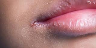 Cracked Corners You May Have Angular Cheilitis Lake Baldwin Dental