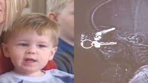 ARCHIVES: In 2008, Kentucky toddler miraculously recovers after key lodged  into brain