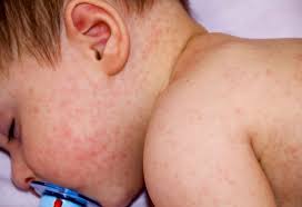 Image result for sweat rash on back baby