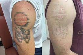 The high energy levels of piqo 4 allow pigment/tattoo removal with fewer treatments compared with other competing laser systems. How Effective Is Laser Tattoo Removal For Colors Guilford Laser Tattoo Removal The Langdon Center
