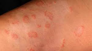Image result for Eczema nummulare