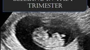 8 Common Causes For Bleeding In The First Trimester Wehavekids