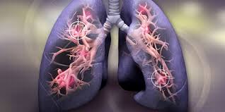 Diseases that attack these organs can cause serious health problems, so the sooner you know about them,. Early Detection Of Lung Cancer In Primary Care Bpacnz