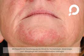 Ducray bietet auch eine dermatologisch getestete ergänzende pflege zur behandlung. Dermanostic Hautlexikon Seborrhoische Ekzem