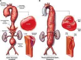 Aortic Aneurysms And Dissections Series Arteriosclerosis Thrombosis And Vascular Biology Abdominal aortic aneurysm (aaa), which is an abnormal focal dilation of the abdominal aorta, is relatively common and has the potential for significant morbidit.