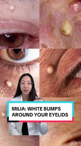Image result for milium cyst on eyelid